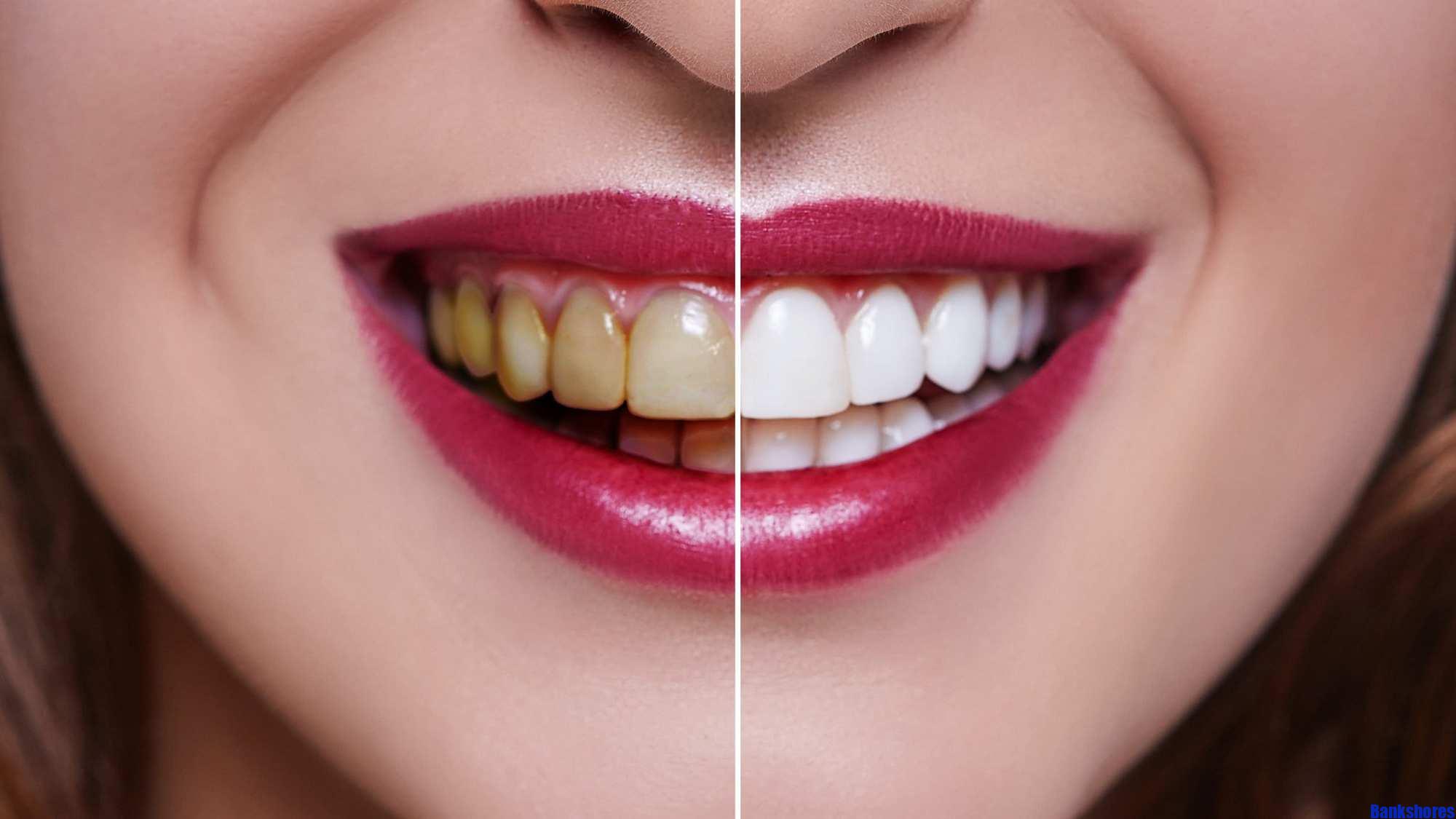 teeth whitening cost without insurance