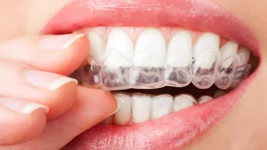 Teeth Whitening Cost - whitening trays